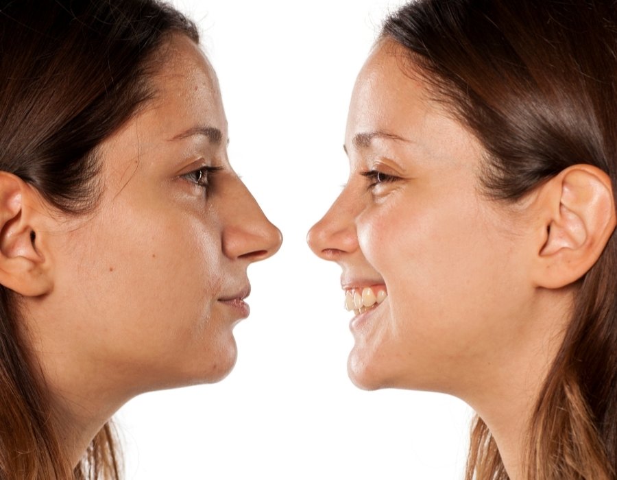 Cirujano especializado en rinoplastia Cirujano especializado en rinoplastia